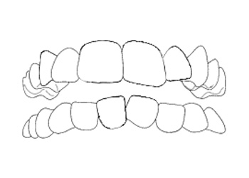 Invisalign Denti Affollati