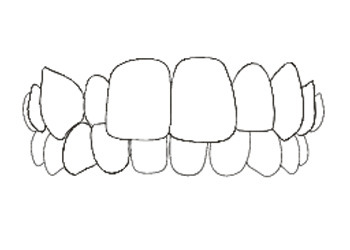 Invisalign Morso Crociato