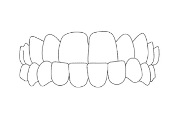 Invisalign Morso Inverso