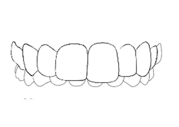 invisalign Morso Inverso