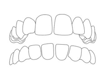 Spazio fra i Denti