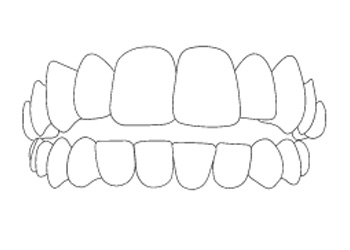 Invisalign Morso Aperto